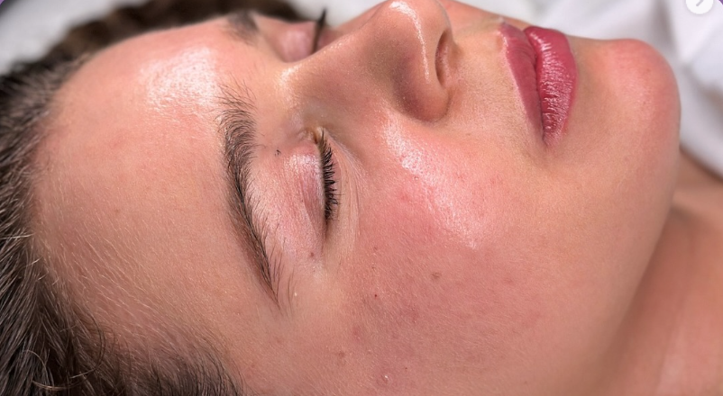 After skin treatment - Independence KY esthetician