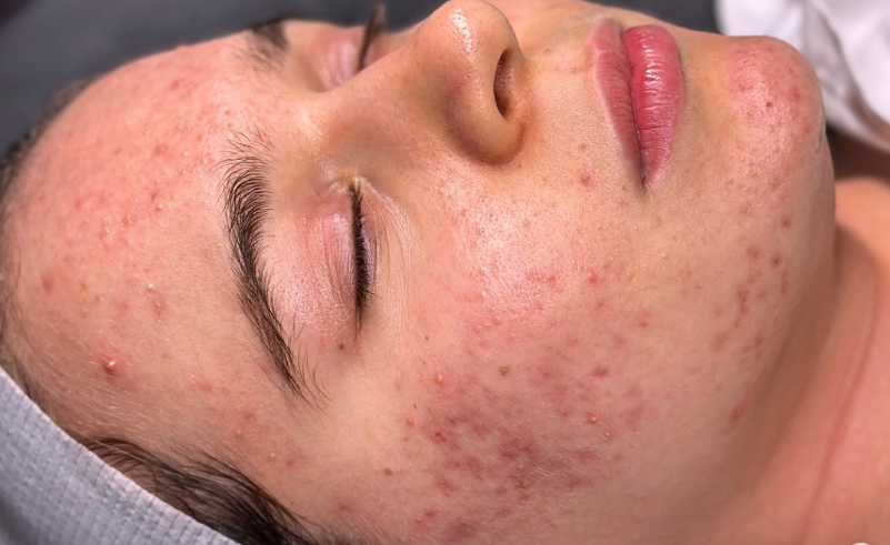 Before skin treatment - Independence KY esthetician